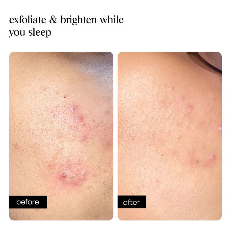 Overnight Peel - AMINU